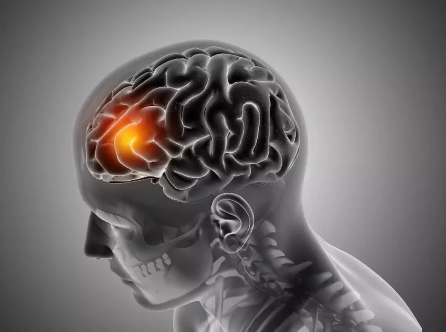 AVC: reconhecer os sinais rapidamente pode salvar vidas