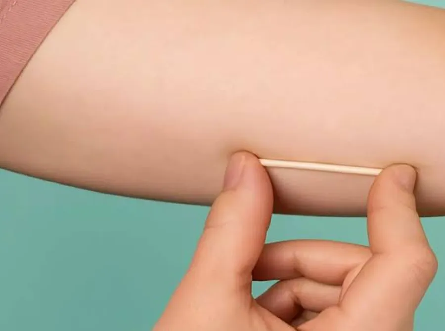 Anvisa aprova uso de implante contraceptivo por até cinco anos no Brasil